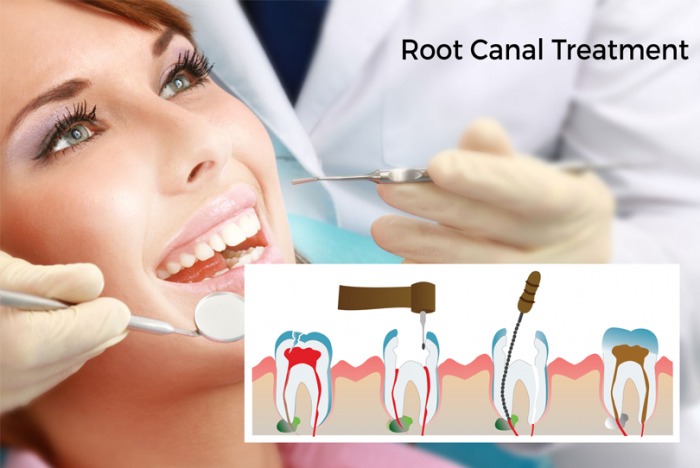 R.C.T. (Root Canal Treatment)